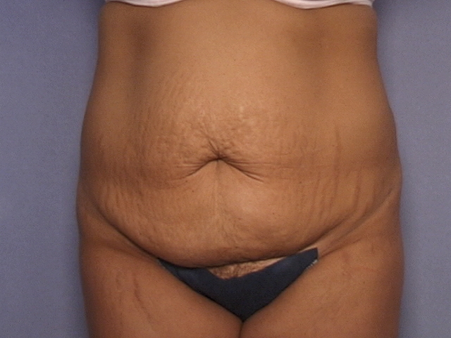 Tummy Tuck Dalton & Chattanooga - Abdominoplasty