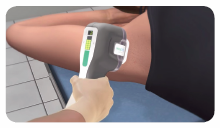 miraDry Treatment